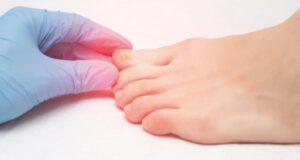 IL GRANULOMA PIOGENICO DEL PIEDE